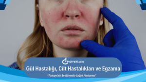 Gül Hastalığı, Cilt Hastalıkları ve Egzama (1)